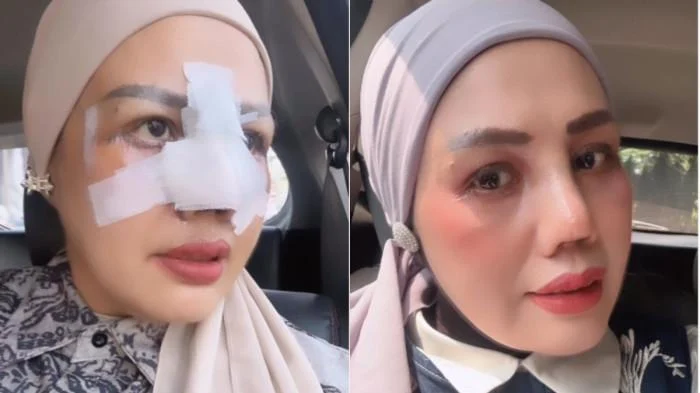 Operasi Plastik Elly Sugigi Hasil Barter Endorse, Nilainya Nyaris Rp100 Juta